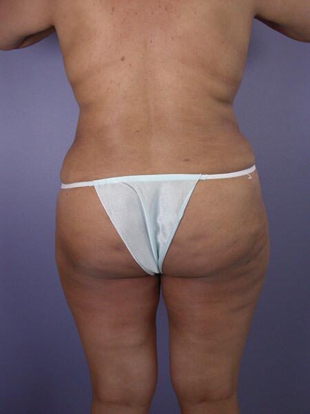 Liposuction Before & After Image