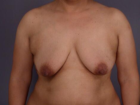 Liposuction Before & After Image