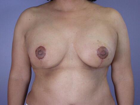 Liposuction Before & After Image