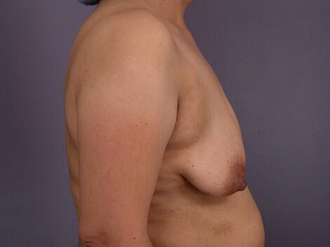 Liposuction Before & After Image