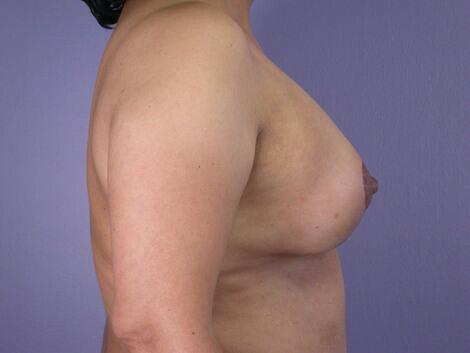 Liposuction Before & After Image