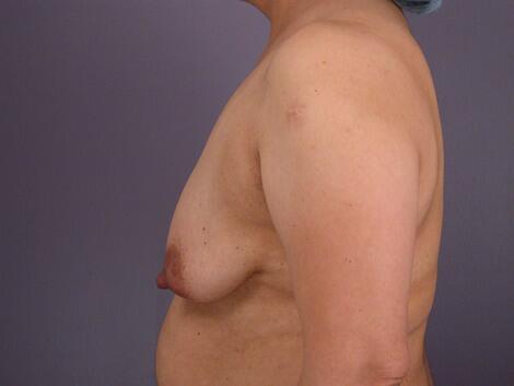 Liposuction Before & After Image