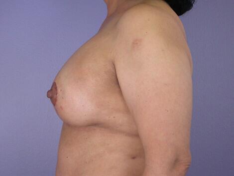 Liposuction Before & After Image