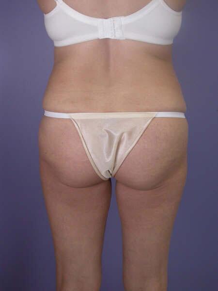 Liposuction Before & After Image