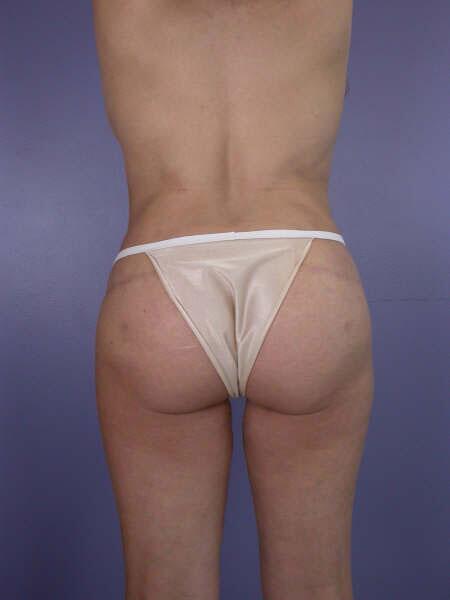 Liposuction Before & After Image