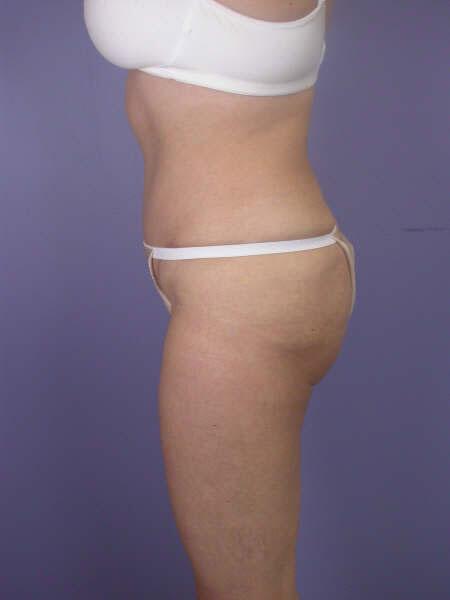 Liposuction Before & After Image