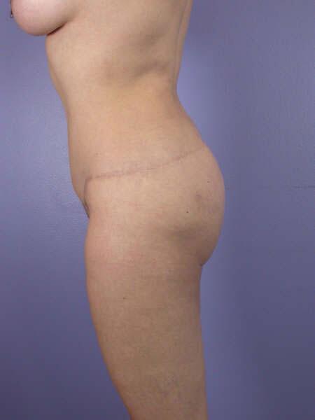 Liposuction Before & After Image