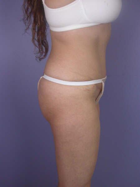 Liposuction Before & After Image