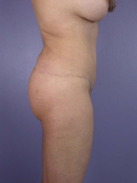 Liposuction Before & After Image