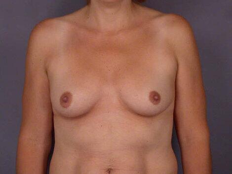 Liposuction Before & After Image