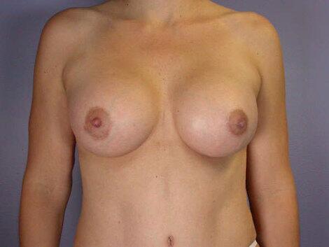 Liposuction Before & After Image