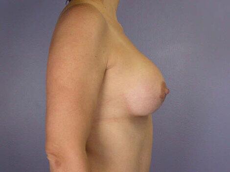 Liposuction Before & After Image