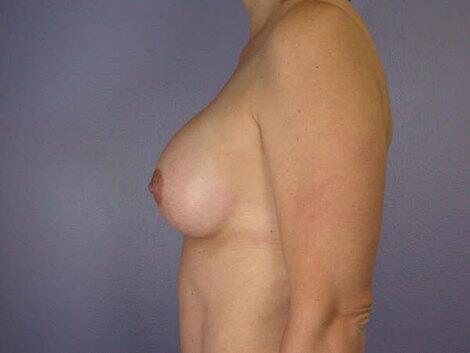 Liposuction Before & After Image