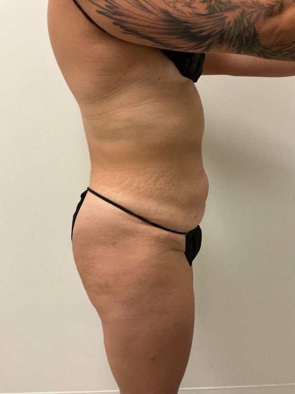 Liposuction Before & After Image