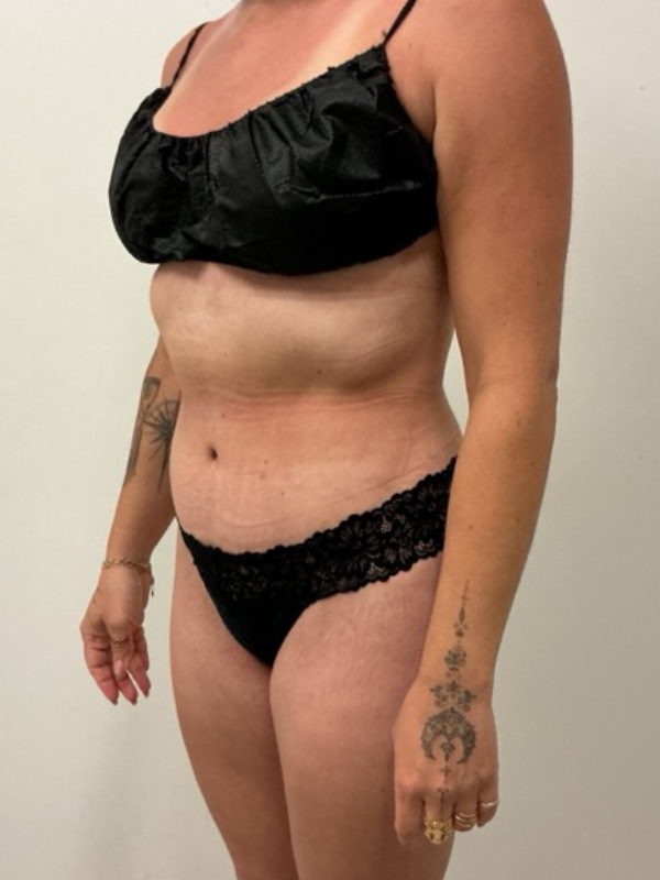 Liposuction Before & After Image