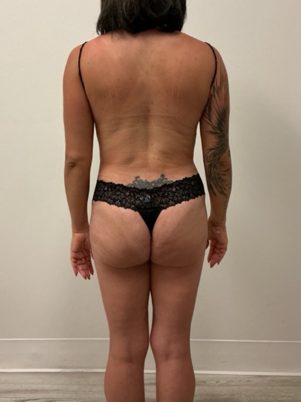 Liposuction Before & After Image