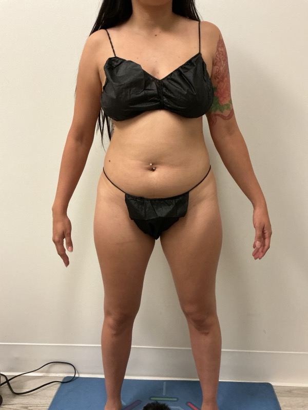 Liposuction Before & After Image