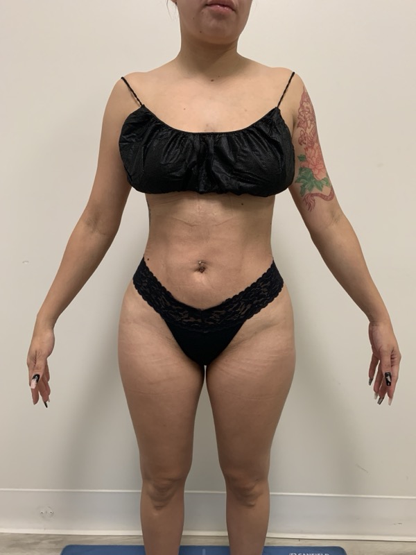 Liposuction Before & After Image