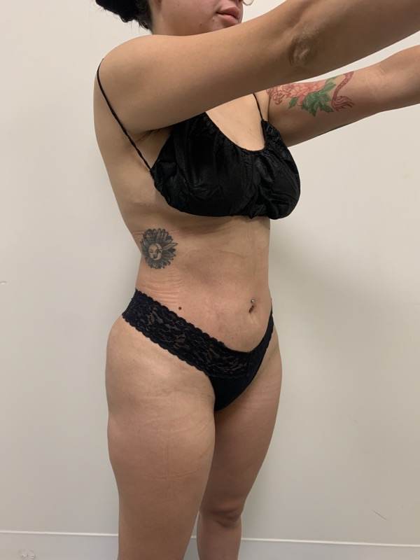 Liposuction Before & After Image