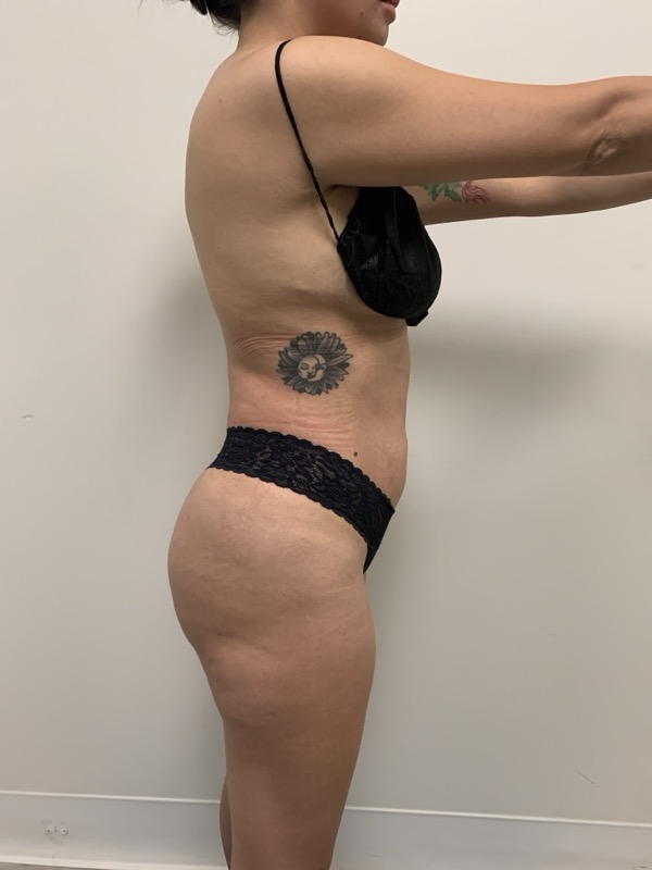 Liposuction Before & After Image