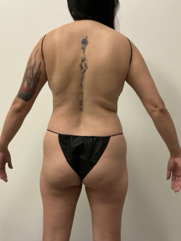 Liposuction Before & After Image