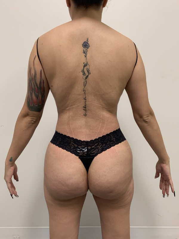 Liposuction Before & After Image