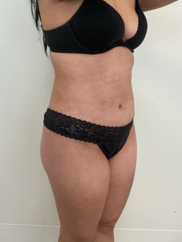 Liposuction Before & After Image