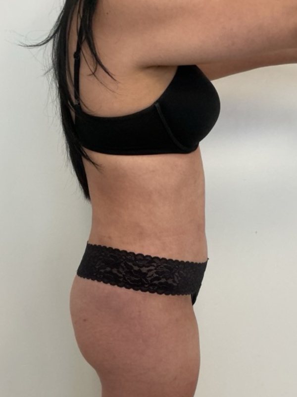 Liposuction Before & After Image