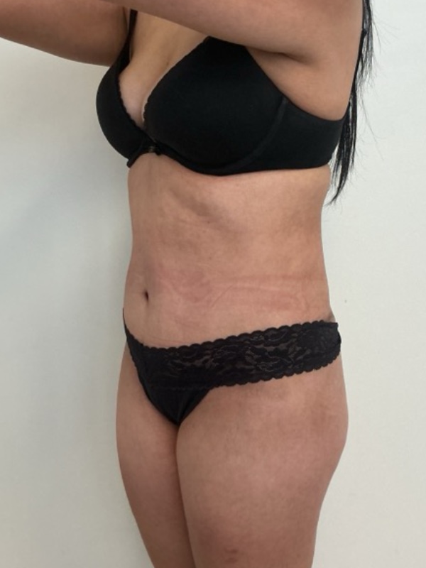 Liposuction Before & After Image