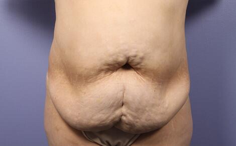 Liposuction Before & After Image