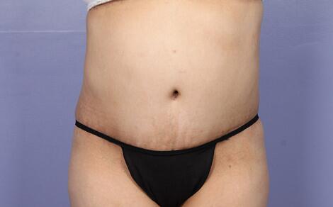 Liposuction Before & After Image