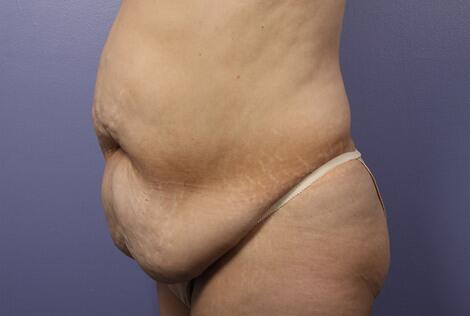 Liposuction Before & After Image