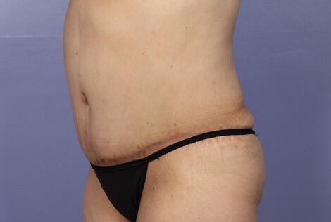 Liposuction Before & After Image