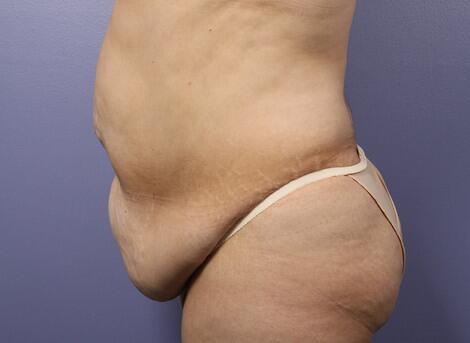 Liposuction Before & After Image