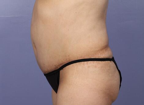 Liposuction Before & After Image