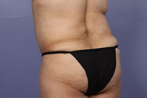 Liposuction Before & After Image