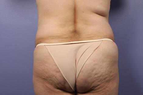 Liposuction Before & After Image