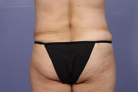 Liposuction Before & After Image