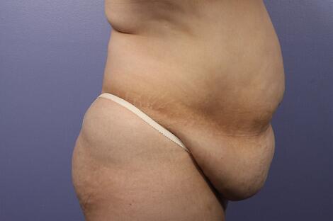 Liposuction Before & After Image