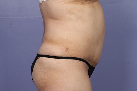 Liposuction Before & After Image