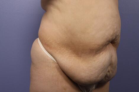 Liposuction Before & After Image