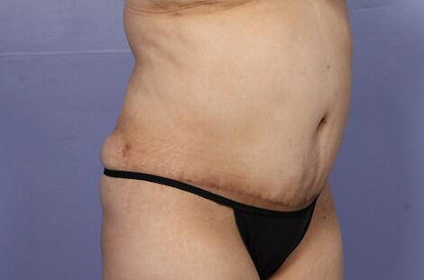 Liposuction Before & After Image