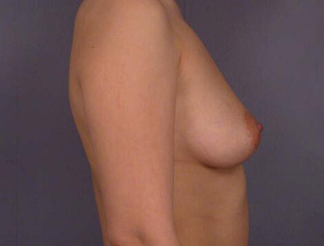 Liposuction Before & After Image