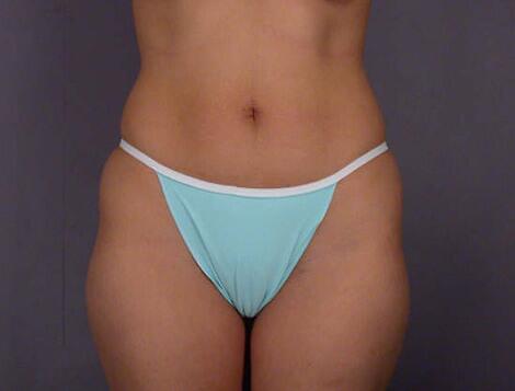 Liposuction Before & After Image