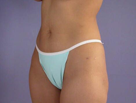 Liposuction Before & After Image