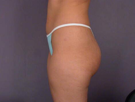 Liposuction Before & After Image