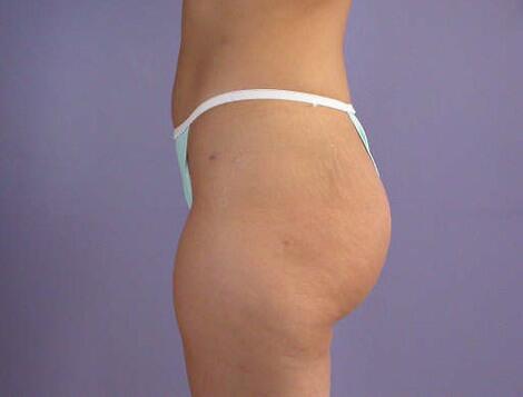 Liposuction Before & After Image