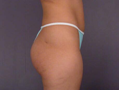 Liposuction Before & After Image