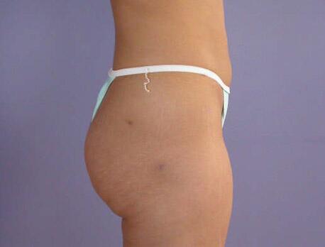 Liposuction Before & After Image