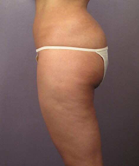 Liposuction Before & After Image